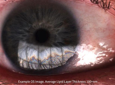 LipiView® II Ocular Surface Interferometer image close-up of eyeball 